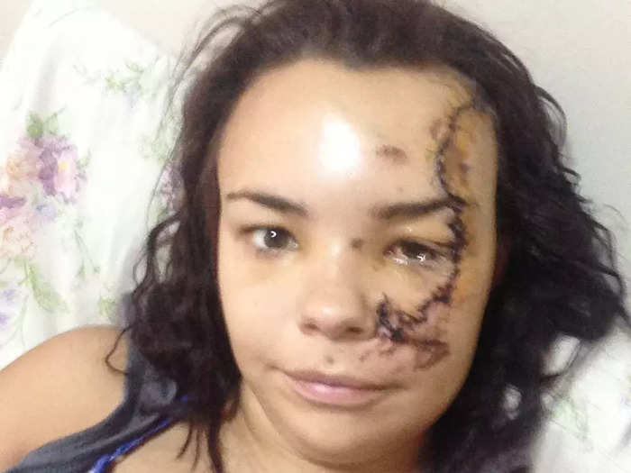 Phyllida Swift, 29, of London, was in a car accident in 2015 that left scars on her face.