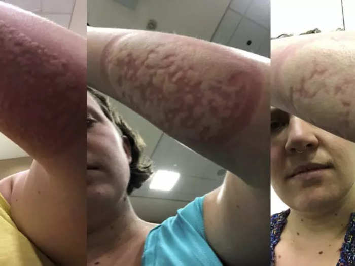 Carolina Reid, a chef in Seattle, got bit by more than 600 mosquitoes for $4,200