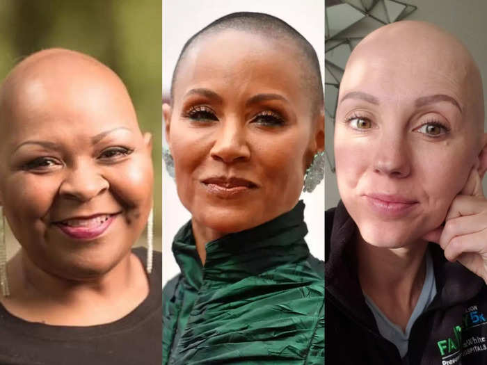 In 2022, the FDA finally approved a treatment for alopecia areata, the balding condition Jada Pinkett Smith has