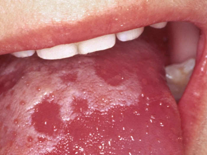 Scarlet fever killed at least 25 children in the UK, who had a nasty version of strep.