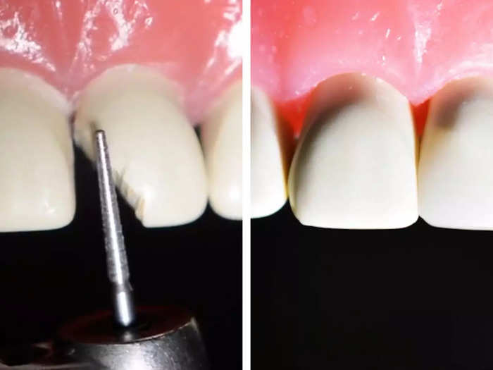 Dentists can color-match your teeth with the resin