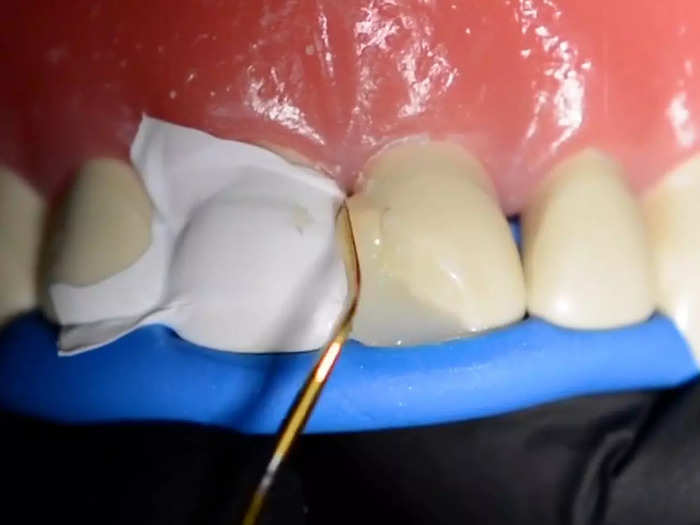 As the resin builds up, the dentist uses fine-tipped tools to smooth is out