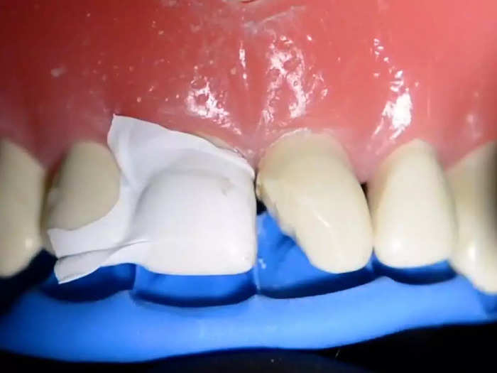 The dentist uses a blue putty as a mold to shape the new tooth