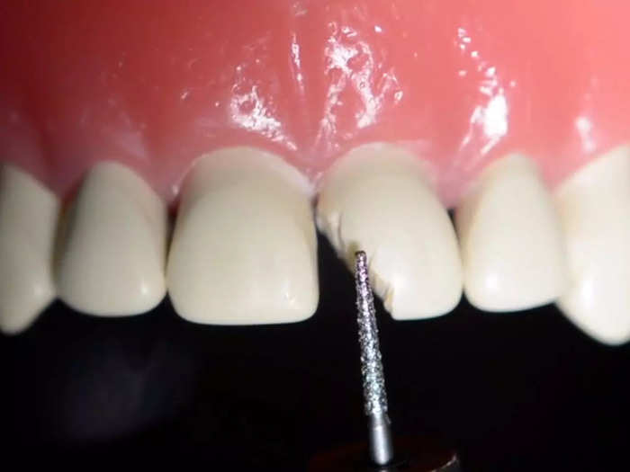 Mending a chipped tooth is a mixture of chemistry and craftsmanship.