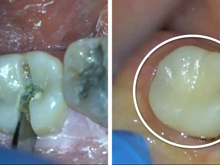 This is how the tooth looks after it is treated.