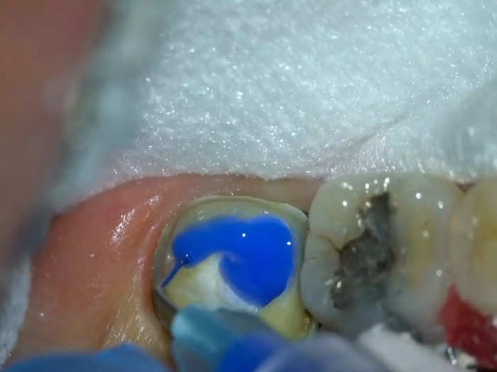 Once the tooth is cleaned, the tooth can be restored.