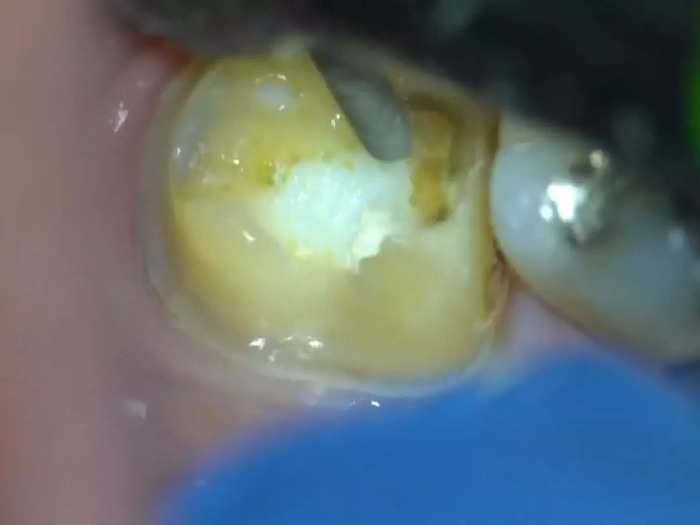 Once the crown is removed, the tooth can be exposed.