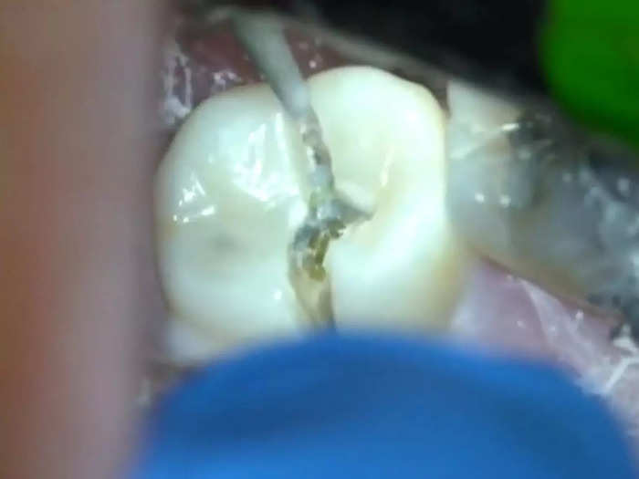 To remove the crown, the dentist slices it in half and chips it off.