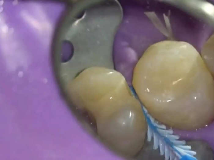 This is what the tooth looks like after the repair.