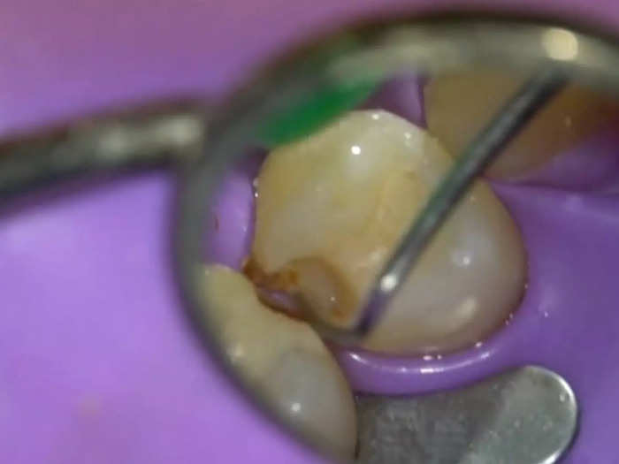 The tooth is shown here after the drilling.