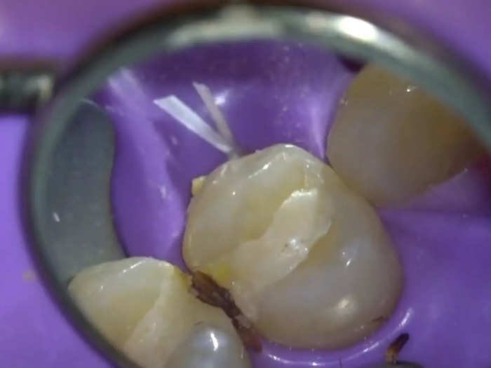 This is a tooth with a broken filling. A cavity has developed on its side.