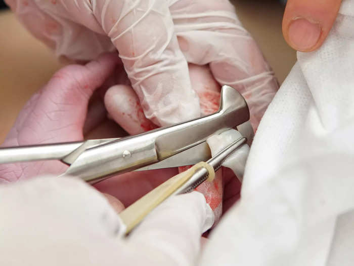 If the newborn is healthy, nurses clamp and cut the umbilical cord about a minute after delivery.
