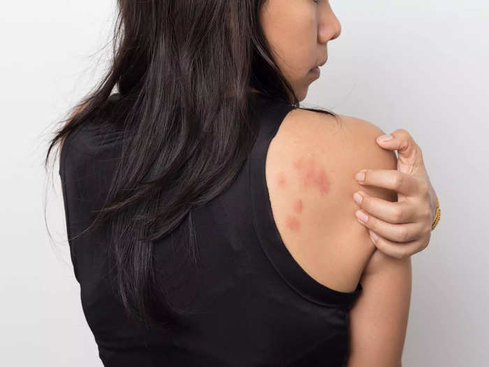 Your skin might react with an acne breakout, hives, or a flare-up of psoriasis, rosacea or eczema.